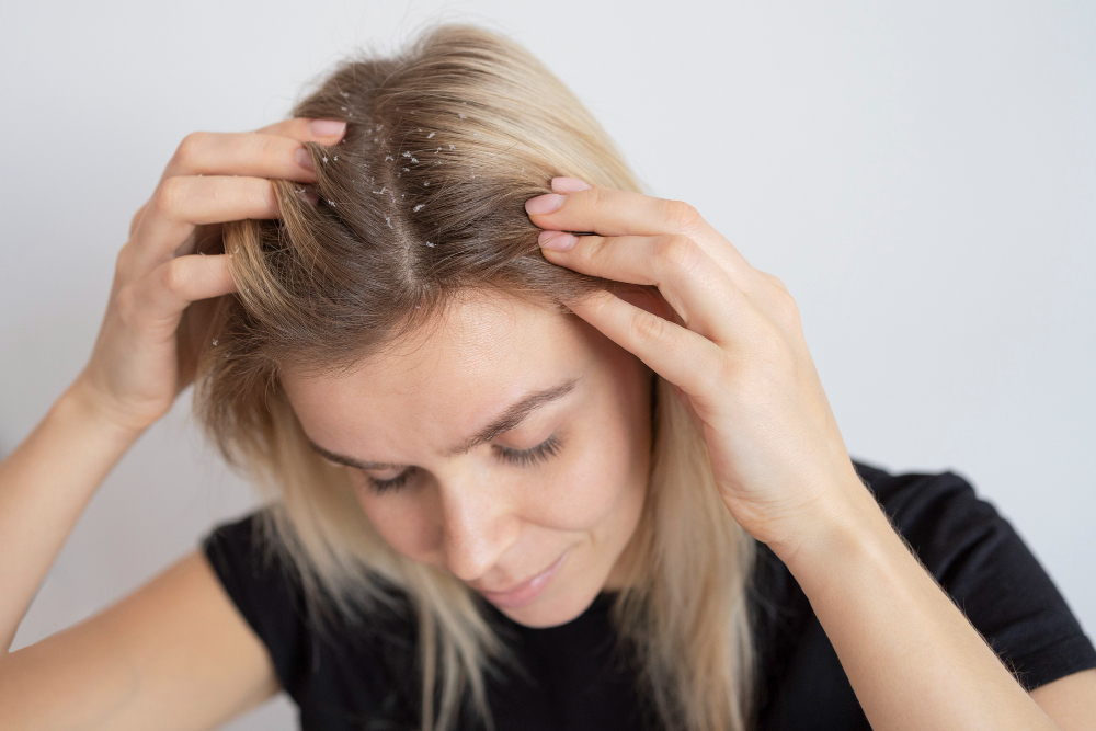 Dandruff Prevention Tips